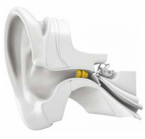 Lyric Hearing Aids