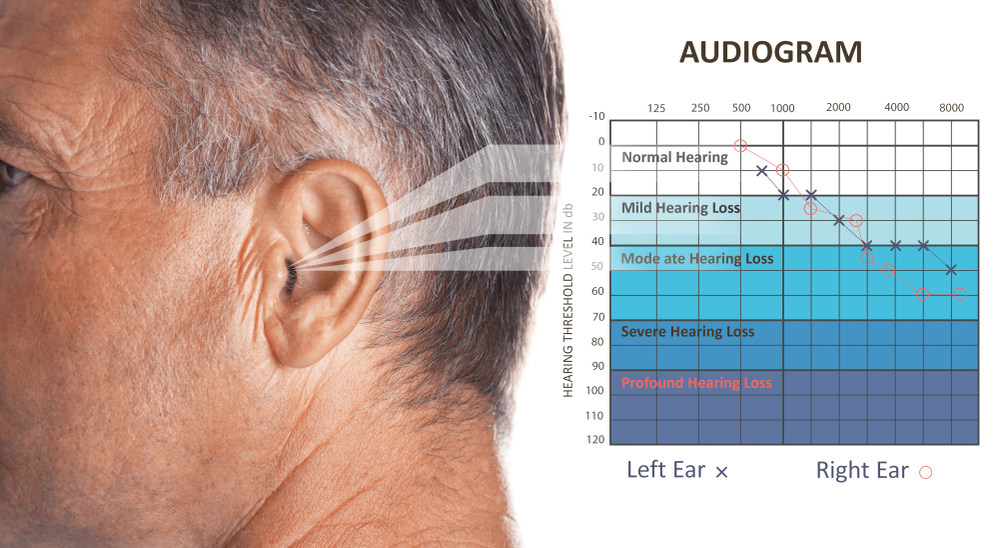 hearing loss nerve damage